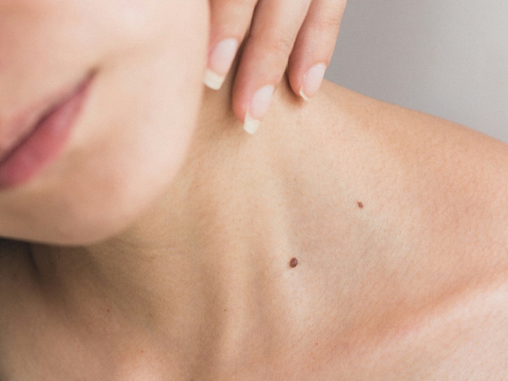 Meet The Founder of Melanoma-Me Foundation This Skin Cancer Awareness Month