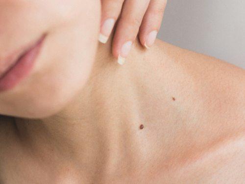 Meet The Founder of Melanoma-Me Foundation This Skin Cancer Awareness Month