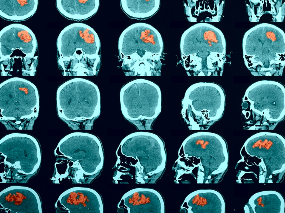 Ct Scans of brain
