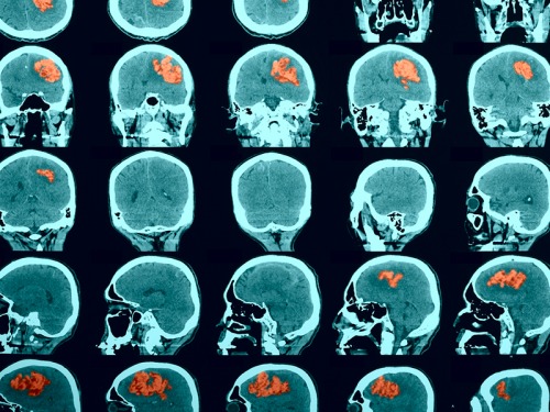 Why We're Supporting The Encephalitis Society at Our York Christmas Fair