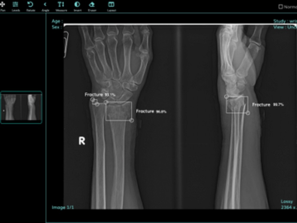 scan of wrist fracture on computer screen